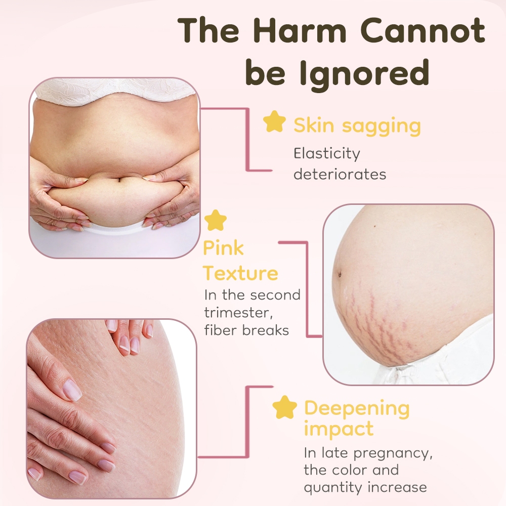 Avinie Stretch Mark Cream BPOM 041024005650400020009 Penghilang Stretch Mark Original Foto 2
